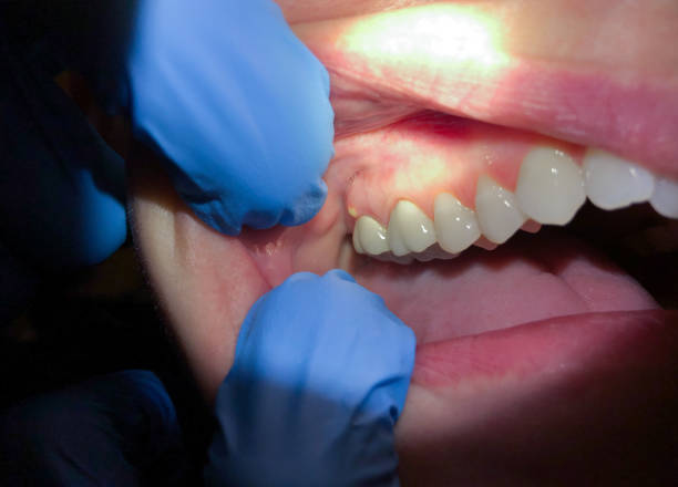 Best Root Canal Emergency Dentist  in Leesport, PA